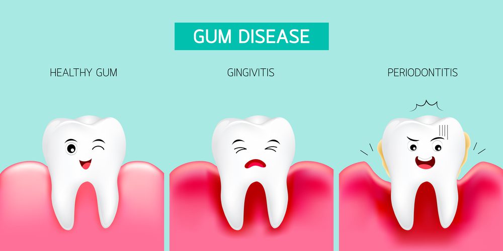 Illustration of the progression of gum disease