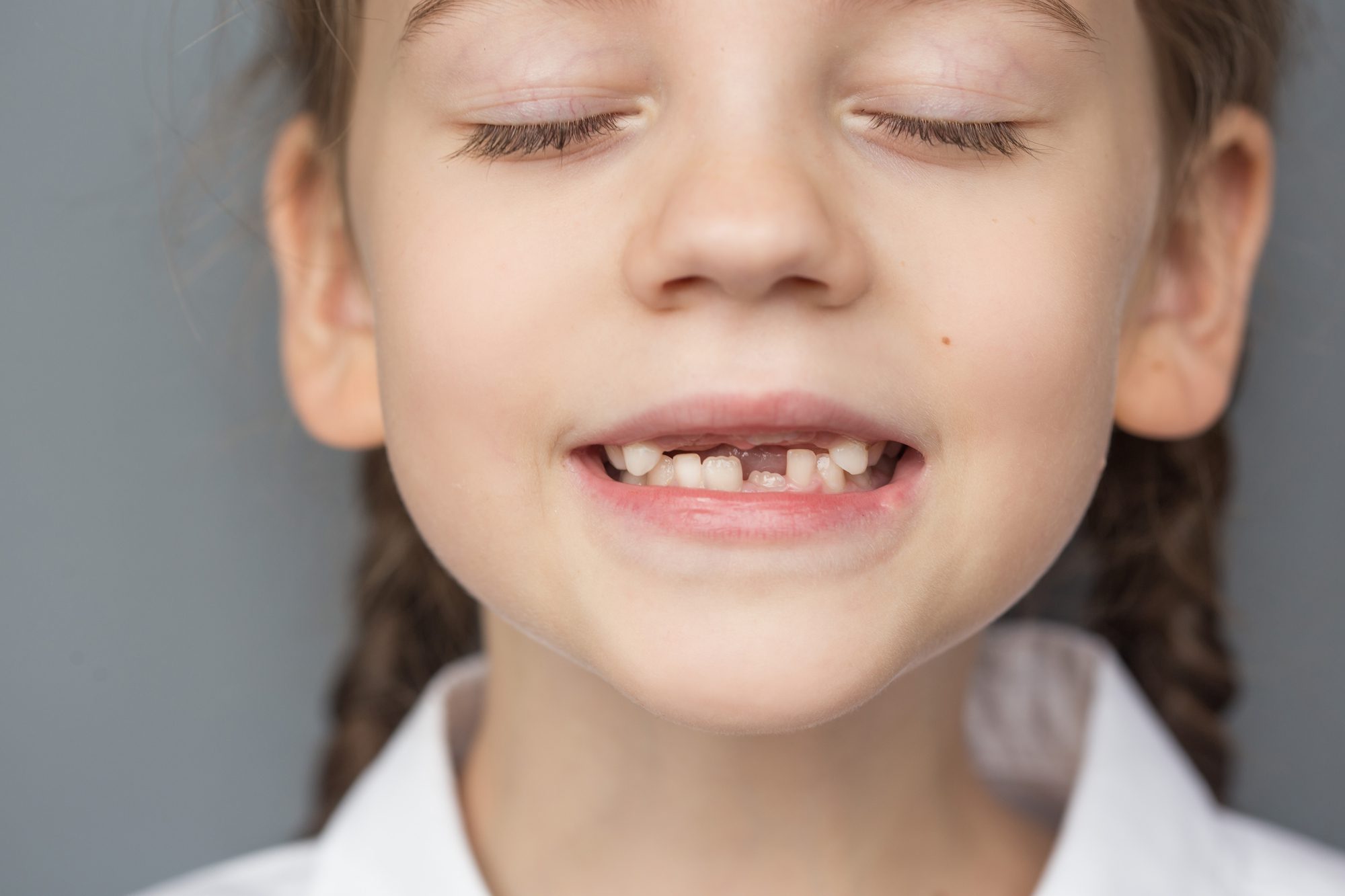 Pediatric Dentistry Why are my child’s permanent teeth coming in yellow?