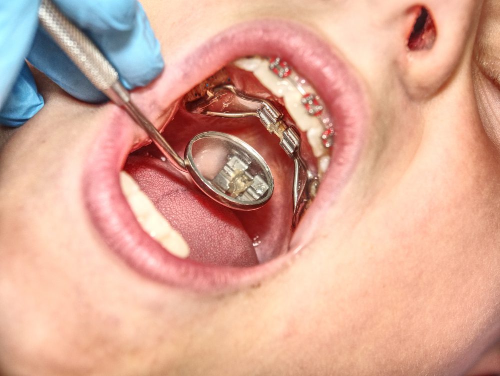 palatal expander in teens mouth